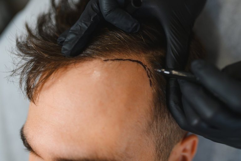 Manos con guantes marcando la línea del pelo en las entradas de un hombre, paso previo de la micropigmentación capilar