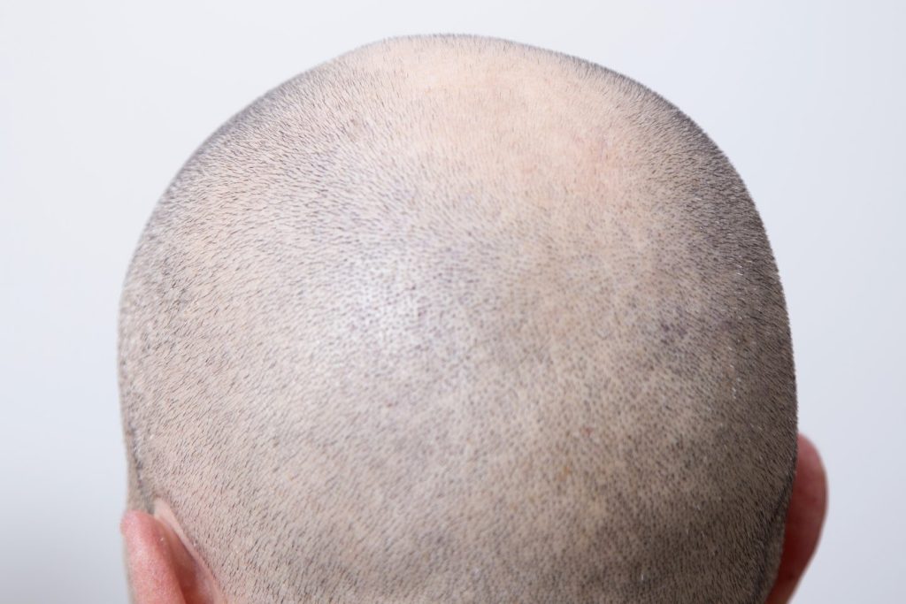 Cabeza rapada vista desde arriba con el punteado de la micropigmentación capilar, que imita el pelo recién cortado